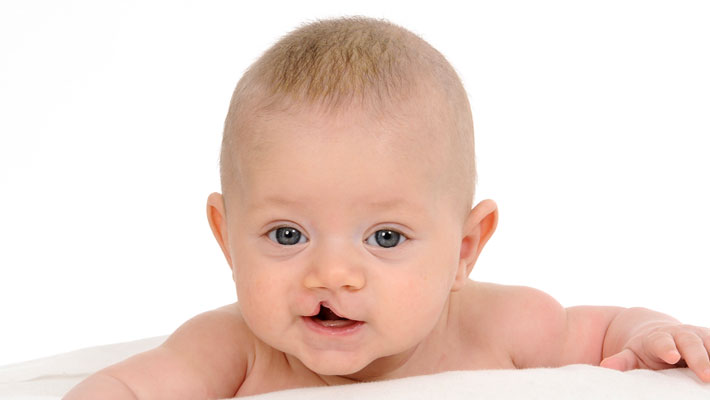 Cleft Lip and Palate