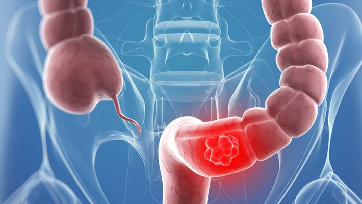 Colorectal Cancer