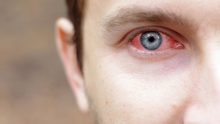 Conjunctivitis
