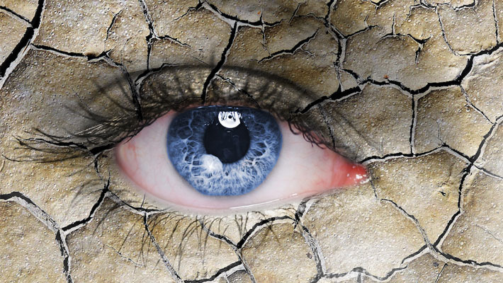 Dry Eyes