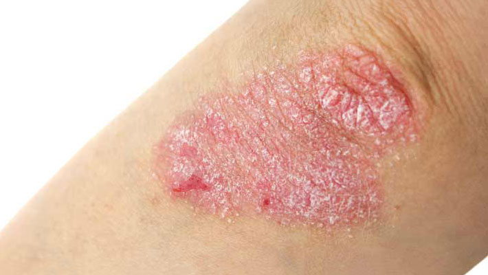 Eczema