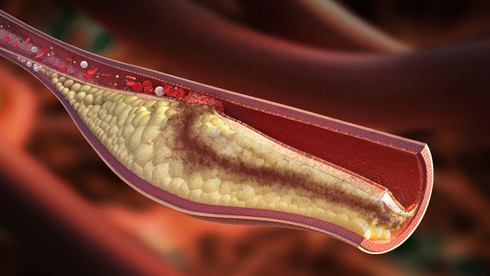 Cholesterol