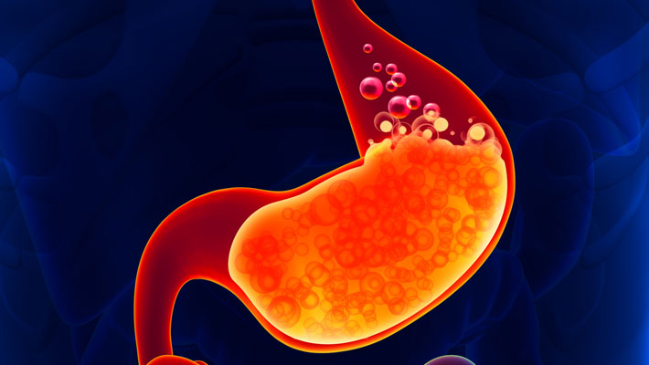 Gastroesophageal Reflux Disease