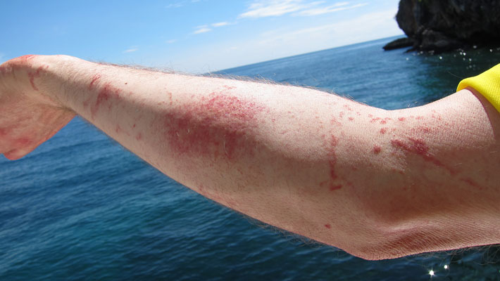 Jellyfish Sting