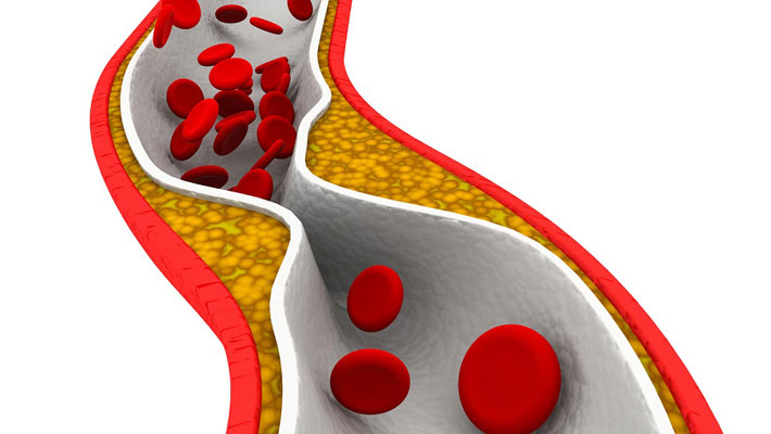 Low-density Lipoprotein (LDL)