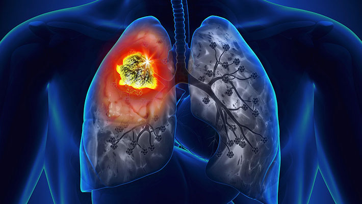 Lung Cancer Symptoms