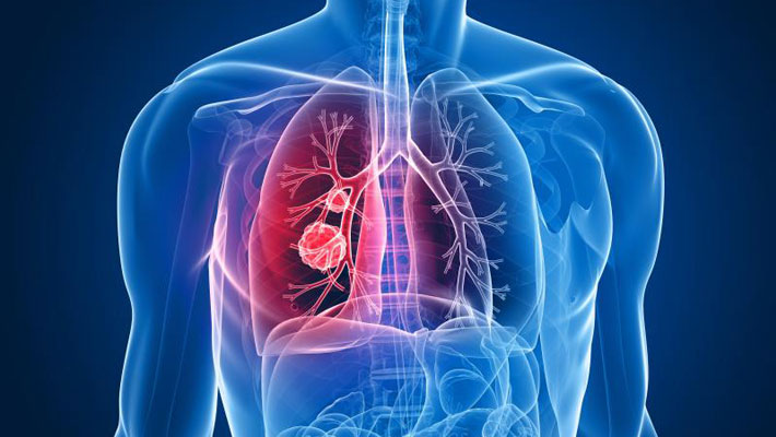 Lung Cancer