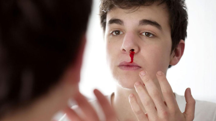BLeeding Nose