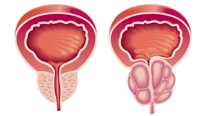 Prostate Cancer