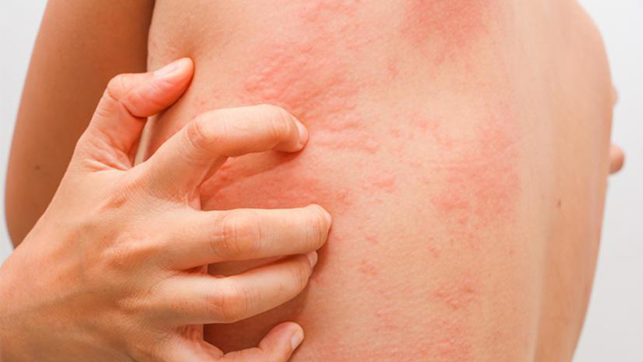 Scabies