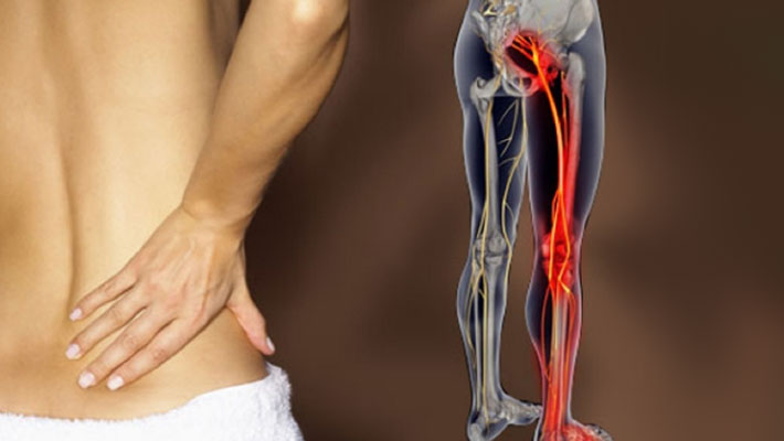 Sciatica Pain