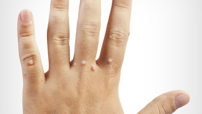 Warts